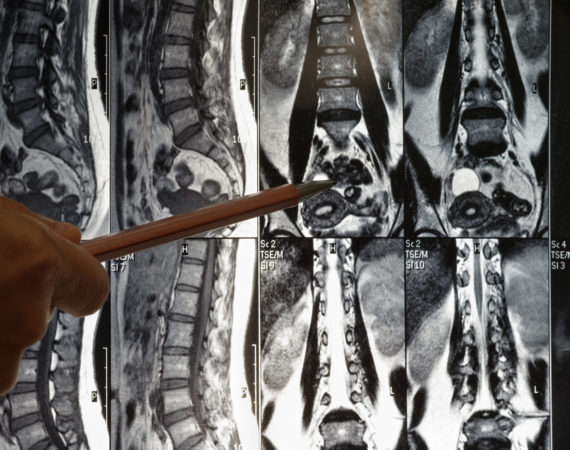 Magnetic resonance imaging of human Cervical over the line, Spine x-ray film